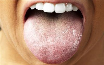 تشخیص سرطان پانکراس با بررسی باکتری زبان!